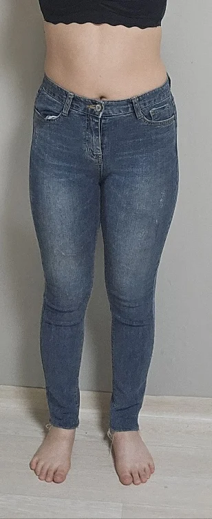 Waist to Saddlebags review!!! - Hip Fat Grafting Before 2 - TheLINE Plastic Surgery
