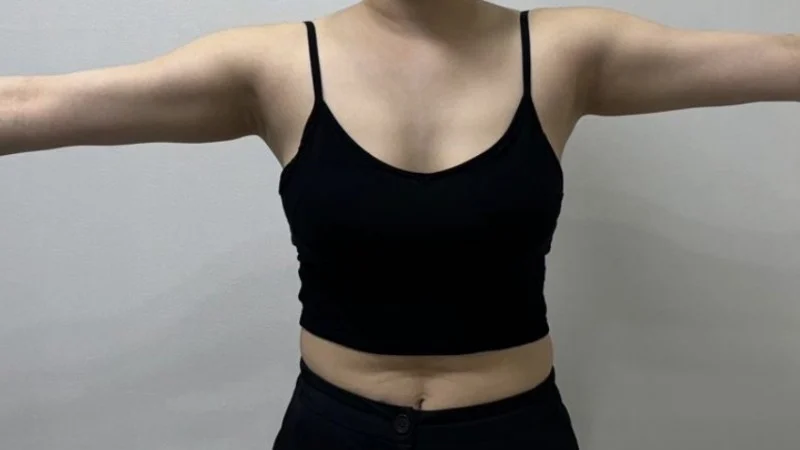 Do not hesitate, just do it - Arm Liposuction Before 2 - TheLINE Plastic Surgery