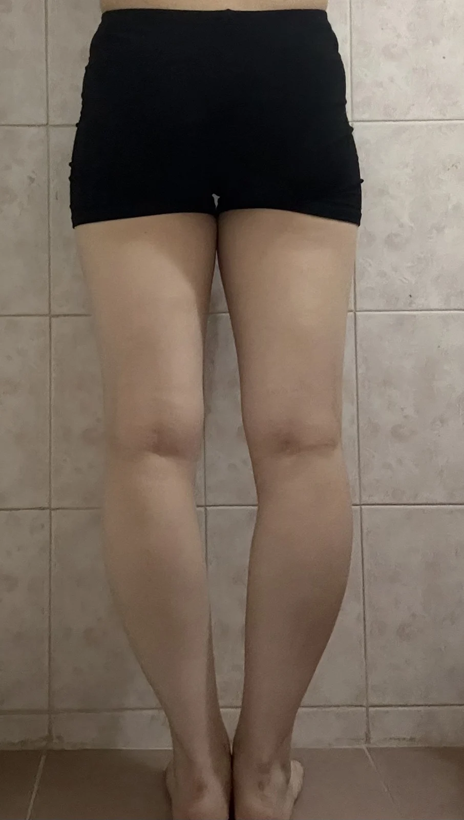 ~1 month after lower body lipo~ - Abdominal Liposuction (Upper Body) Before 2 - TheLINE Plastic Surgery