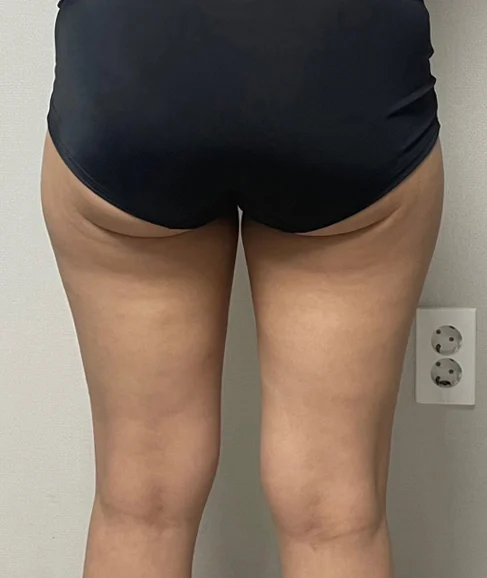 My 6-month thigh liposuction review - Thigh Liposuction (Lower Body) Before 2 - TheLINE Plastic Surgery