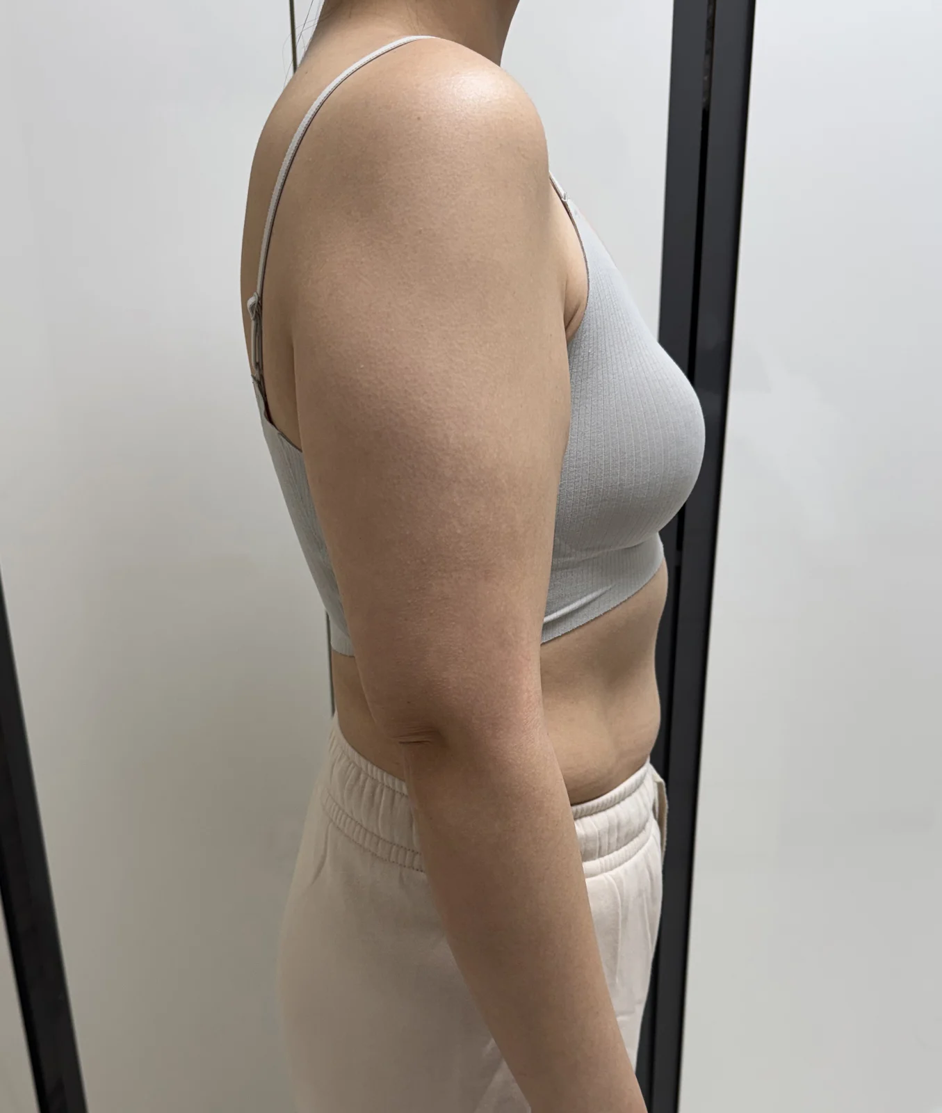 One month since my arm liposuction and a - Body Contouring Before 2 - TheLINE Plastic Surgery
