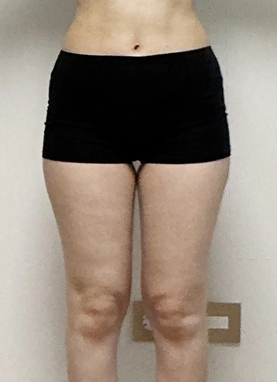 My 3-month post-op review~! - Hip Fat Grafting Before 2 - TheLINE Plastic Surgery