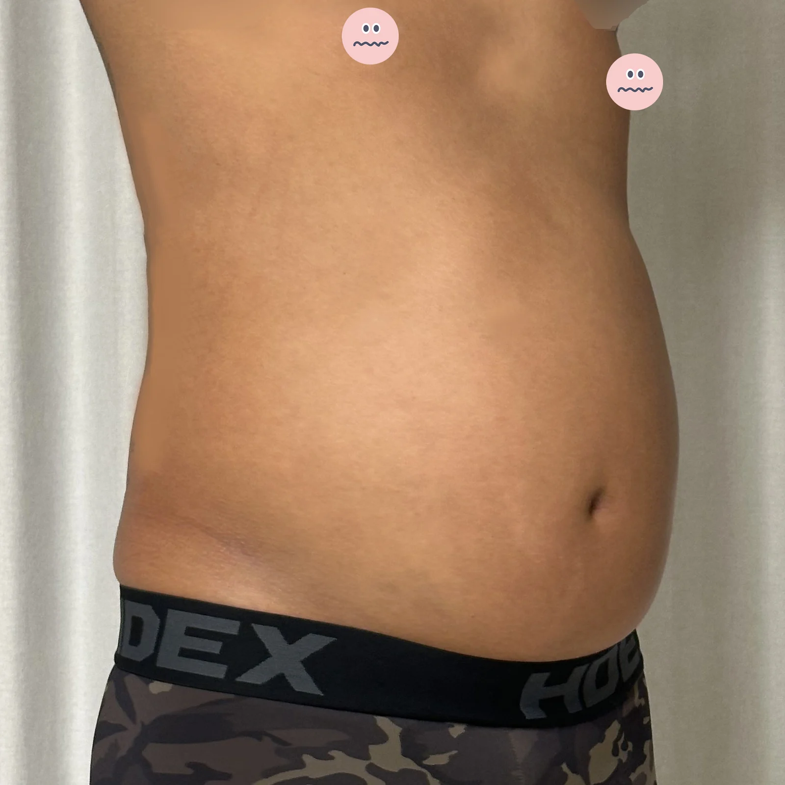 3 months after abdominal liposuction - Abdominal Liposuction (Upper Body) Before 2 - TheLINE Plastic Surgery