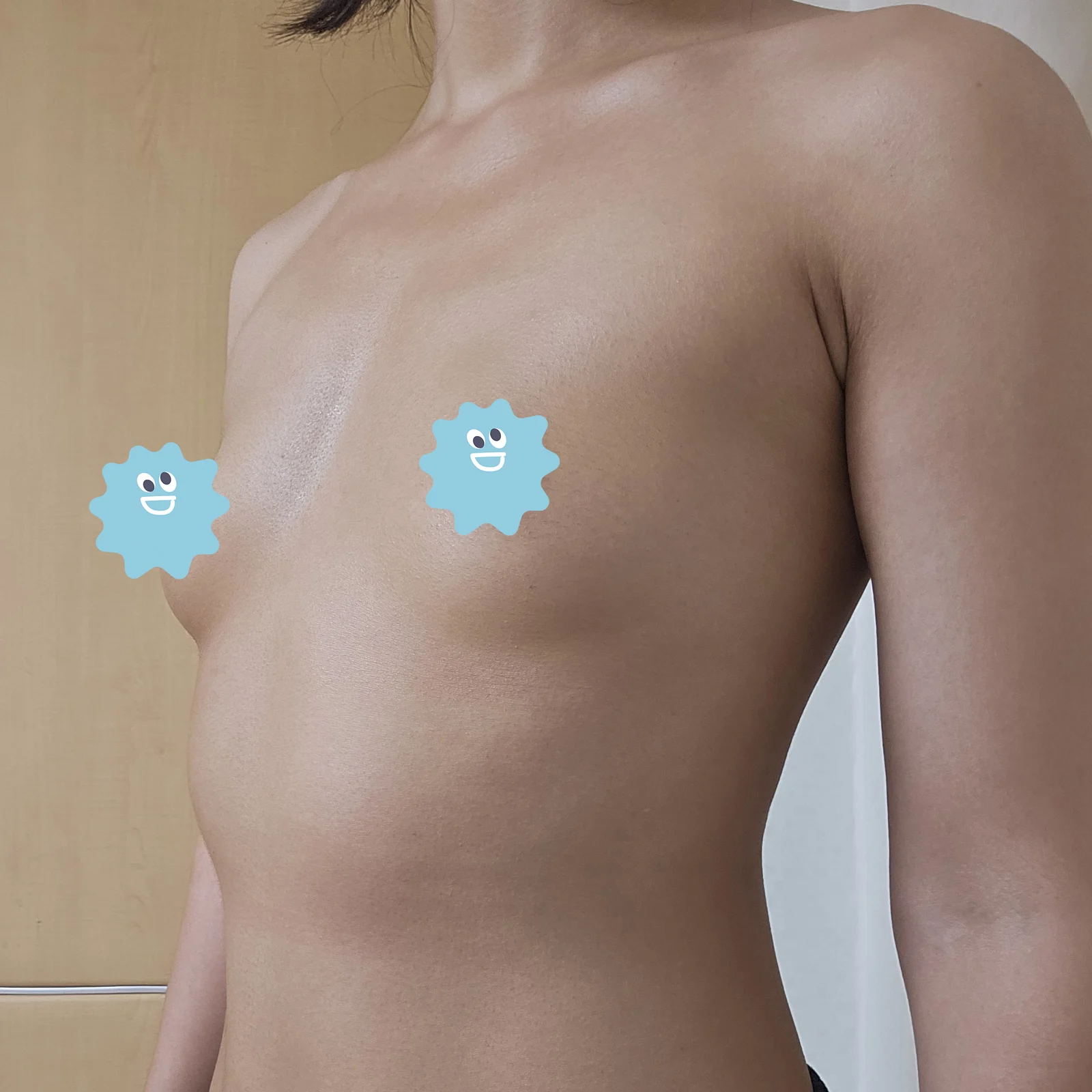 My 3-month breast fat grafting review!! - Body Contouring Before 2 - TheLINE Plastic Surgery