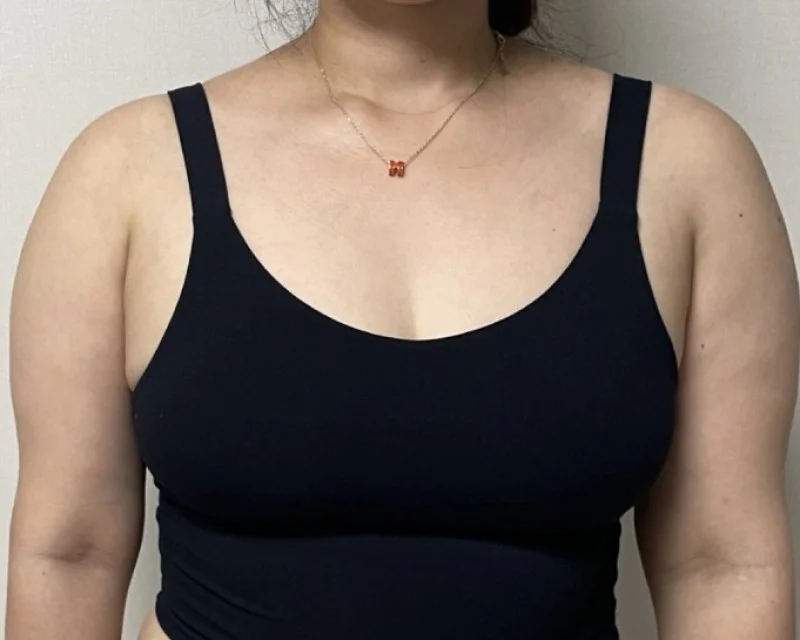 Everyone should do it - Arm Liposuction surgery Before photo - TheLINE Plastic Surgery