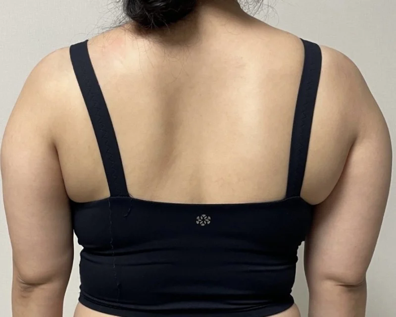 Everyone should do it - Arm Liposuction Before 2 - TheLINE Plastic Surgery
