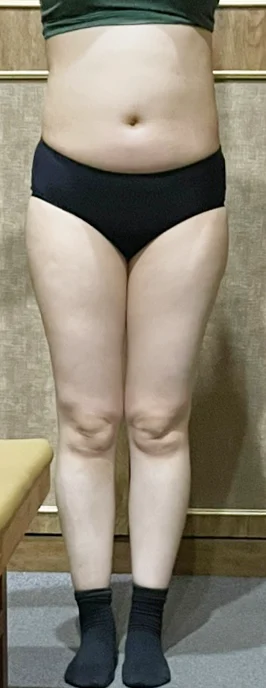 6 months after surgery^^ - Abdominal Liposuction (Upper Body) surgery Before photo - TheLINE Plastic Surgery