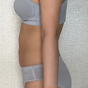 6 months after abdomen and love handle l - Abdominal Liposuction (Upper Body) Before 2 - TheLINE Plastic Surgery