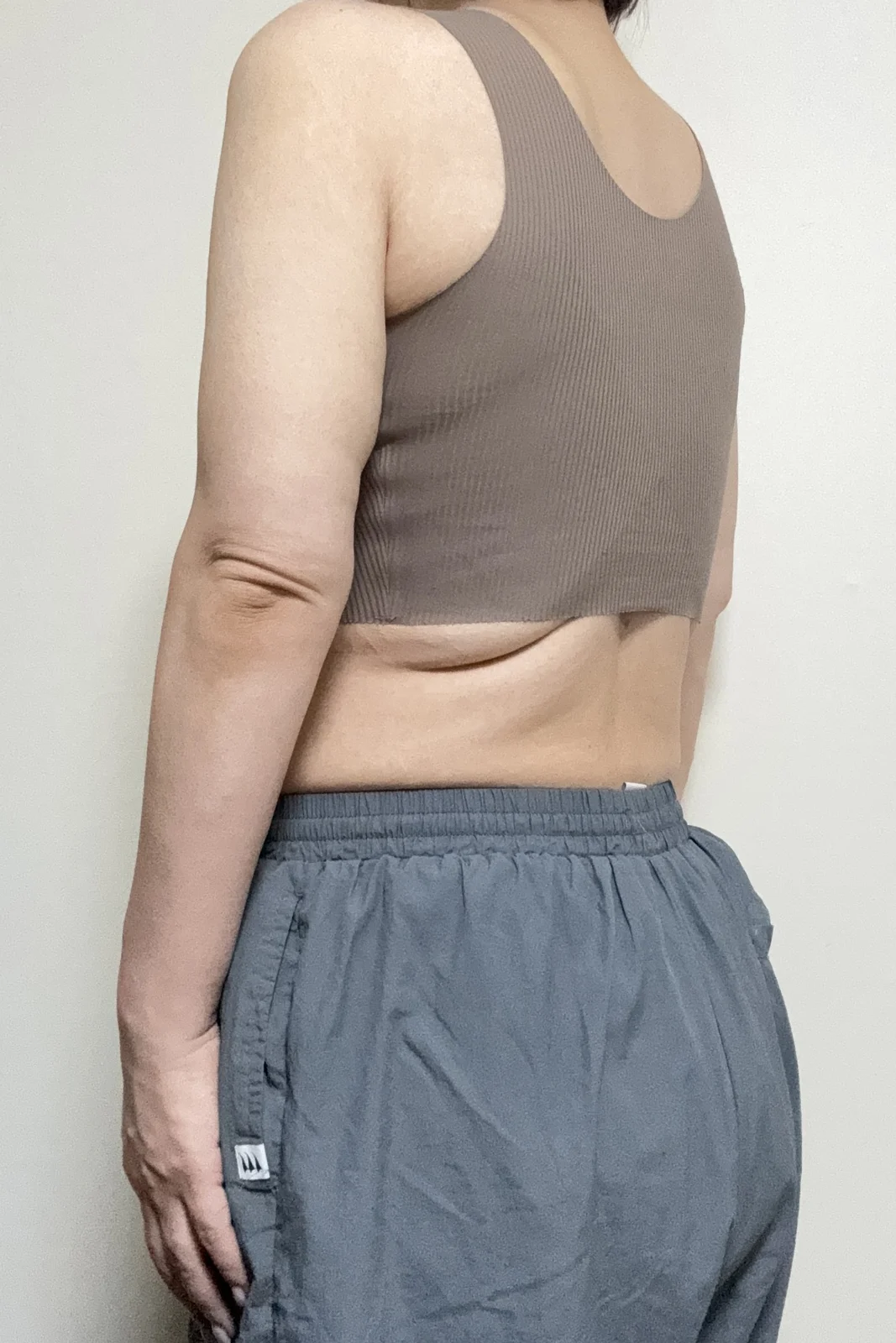 One month after arm liposuction and arm  - Body Contouring Before 2 - TheLINE Plastic Surgery