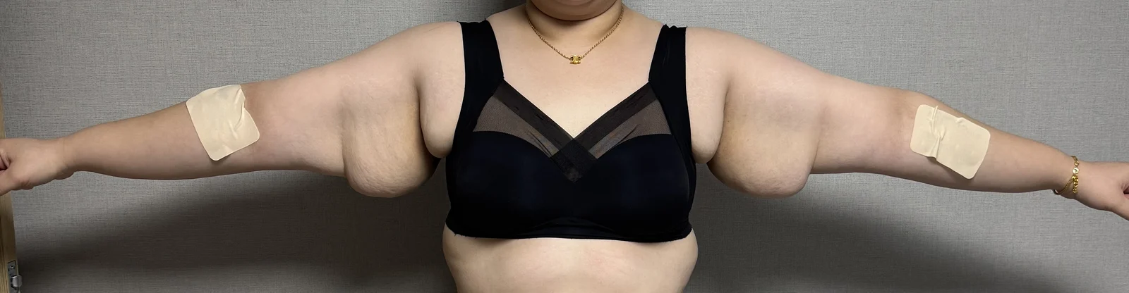 Arm lipo + arm lift surgery review - Body Contouring Before 2 - TheLINE Plastic Surgery