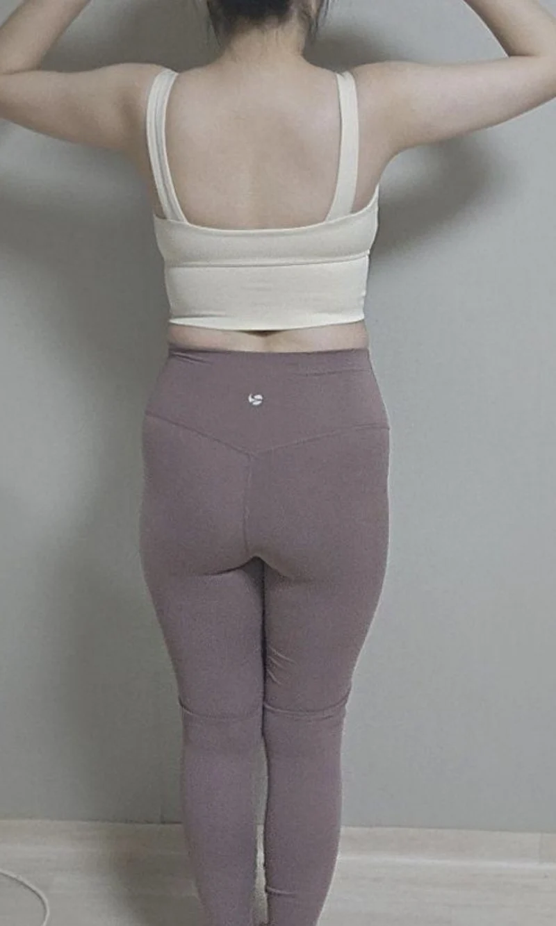 My review after stem cell full-body lipo - Abdominal Liposuction (Upper Body) surgery Before photo - TheLINE Plastic Surgery