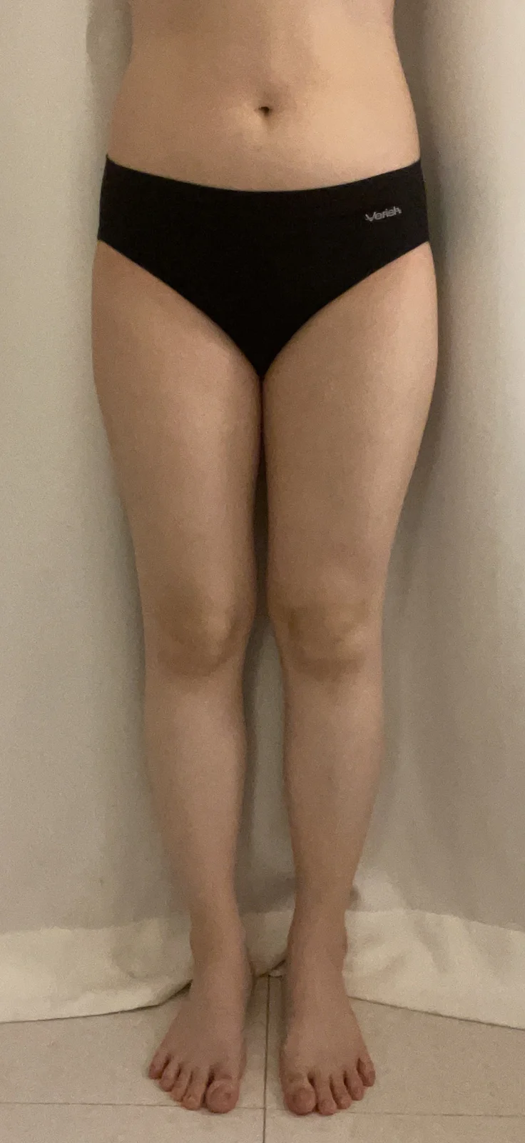 6 months since my hip, thigh and lower a - Thigh Liposuction (Lower Body) Before 2 - TheLINE Plastic Surgery
