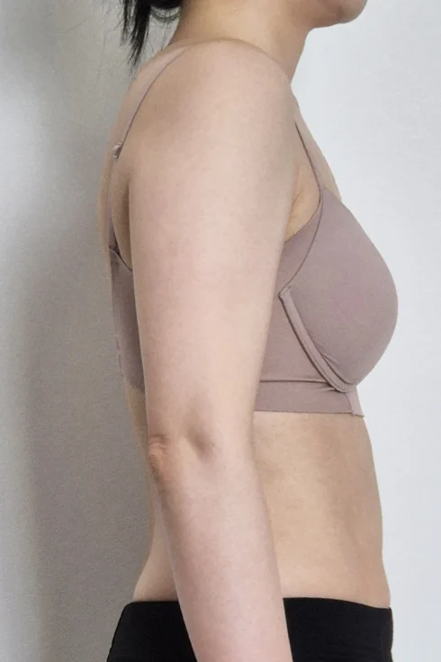 6 months after arm lipo~~ - Arm Liposuction Before 2 - TheLINE Plastic Surgery