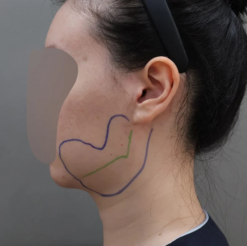 My face looks slimmer after facial lipos - Facial Liposuction Before 2 - TheLINE Plastic Surgery