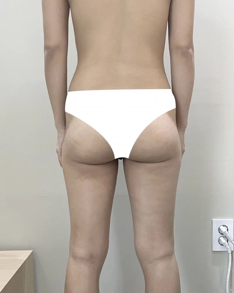 I recommend Dr. Jaeho Cho - Hip Fat Grafting Before 2 - TheLINE Plastic Surgery