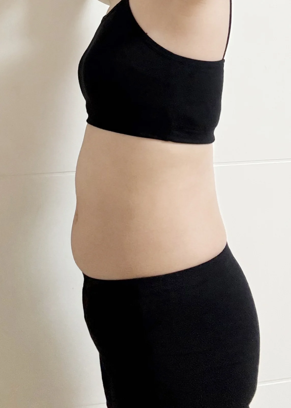 ~3 months after abdominal lipo~ - Abdominal Liposuction (Upper Body) Before 2 - TheLINE Plastic Surgery