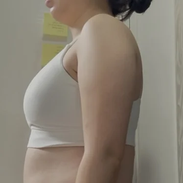 The scars don't show and I'm so happy wi - Arm Liposuction Before 2 - TheLINE Plastic Surgery