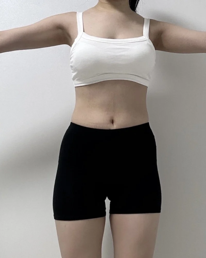 Saddlebag lipo, love handle lipo, hip gr - Abdominal Liposuction (Upper Body) Before 2 - TheLINE Plastic Surgery