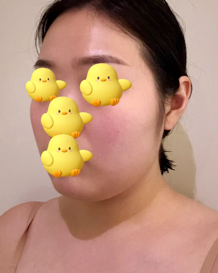 Posting my double chin liposuction revie - Facial Liposuction Before 2 - TheLINE Plastic Surgery