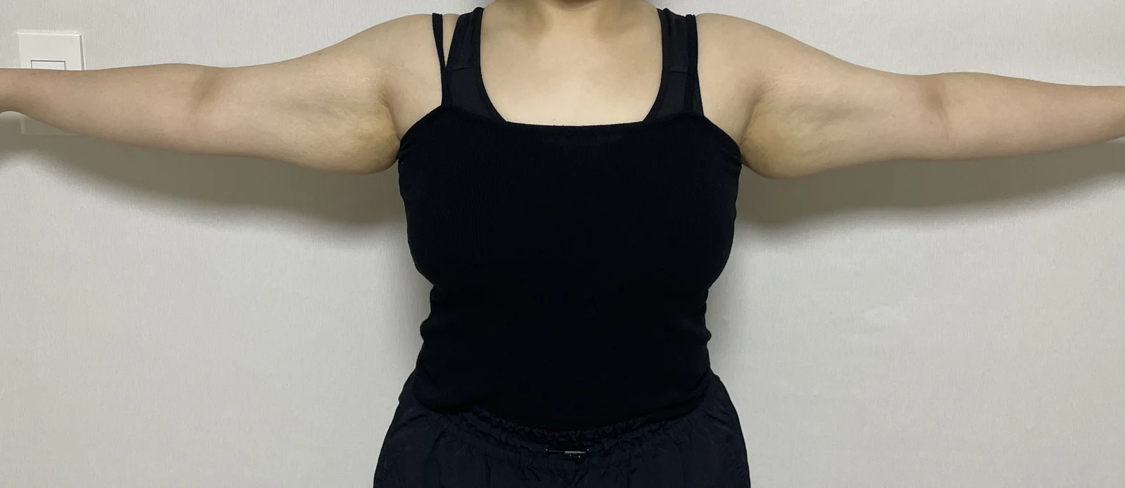 One month after arm lift + liposuction! - Body Contouring Before 2 - TheLINE Plastic Surgery