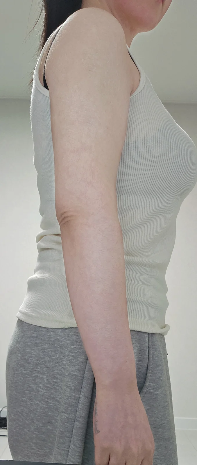 6 months after arm lift and lipo - the f - Body Contouring After 4 - TheLINE Plastic Surgery