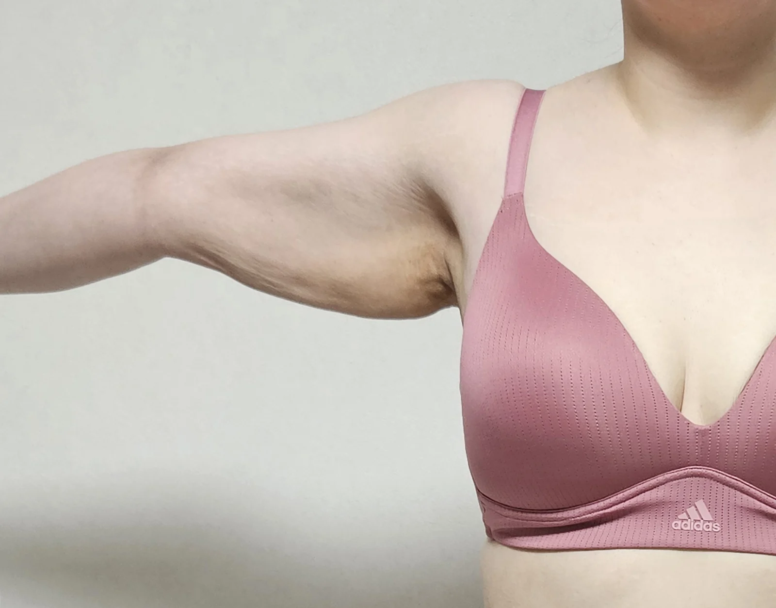 6 months after arm lift and lipo - the f - Body Contouring surgery Before photo - TheLINE Plastic Surgery