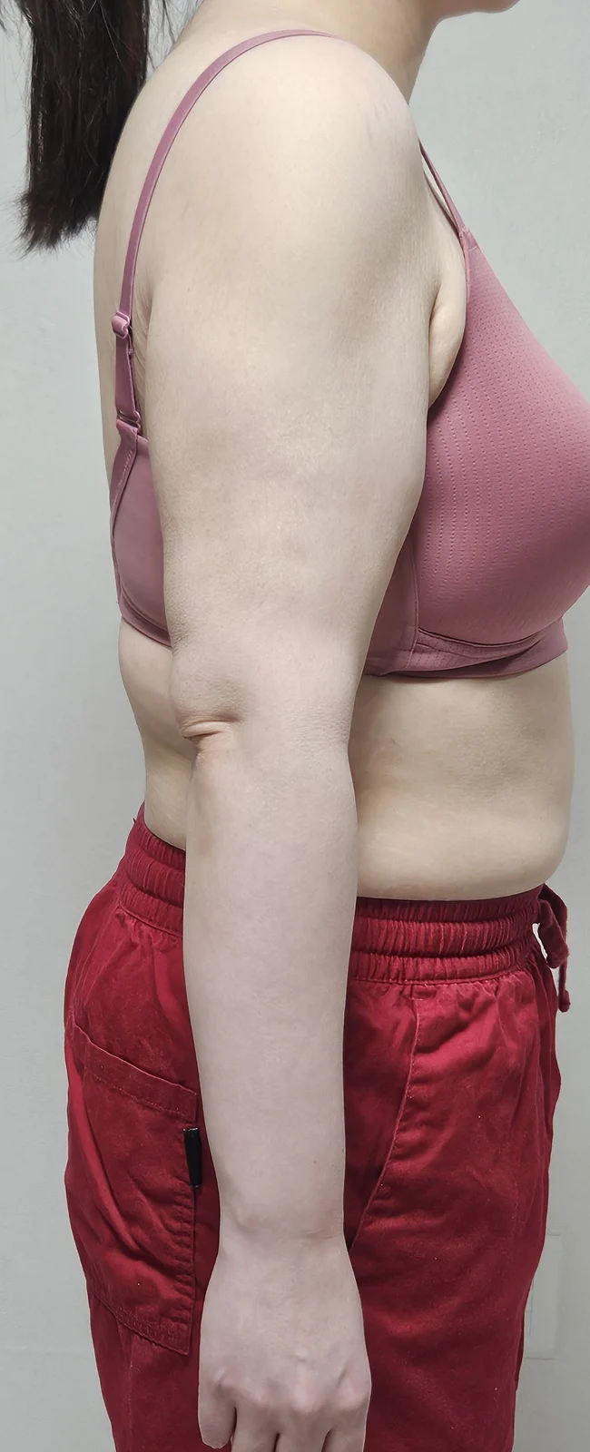 6 months after arm lift and lipo - the f - Body Contouring Before 2 - TheLINE Plastic Surgery