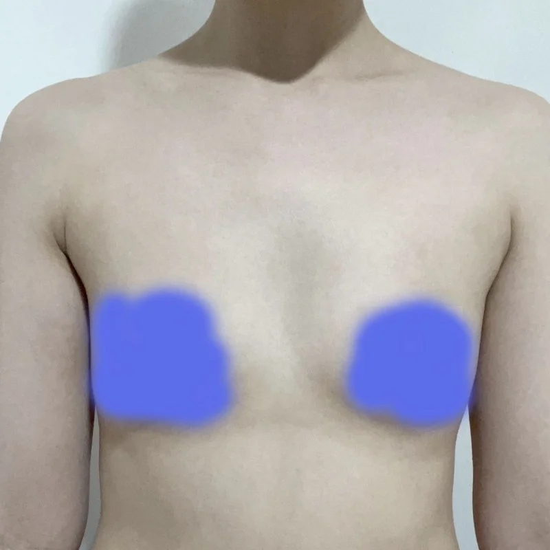 The shape looks pretty - Breast Fat Grafting surgery Before photo - TheLINE Plastic Surgery