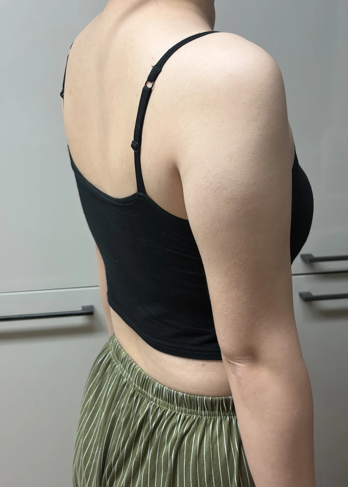 My one-month review of upper arm liposuc - Arm Liposuction surgery Before photo - TheLINE Plastic Surgery