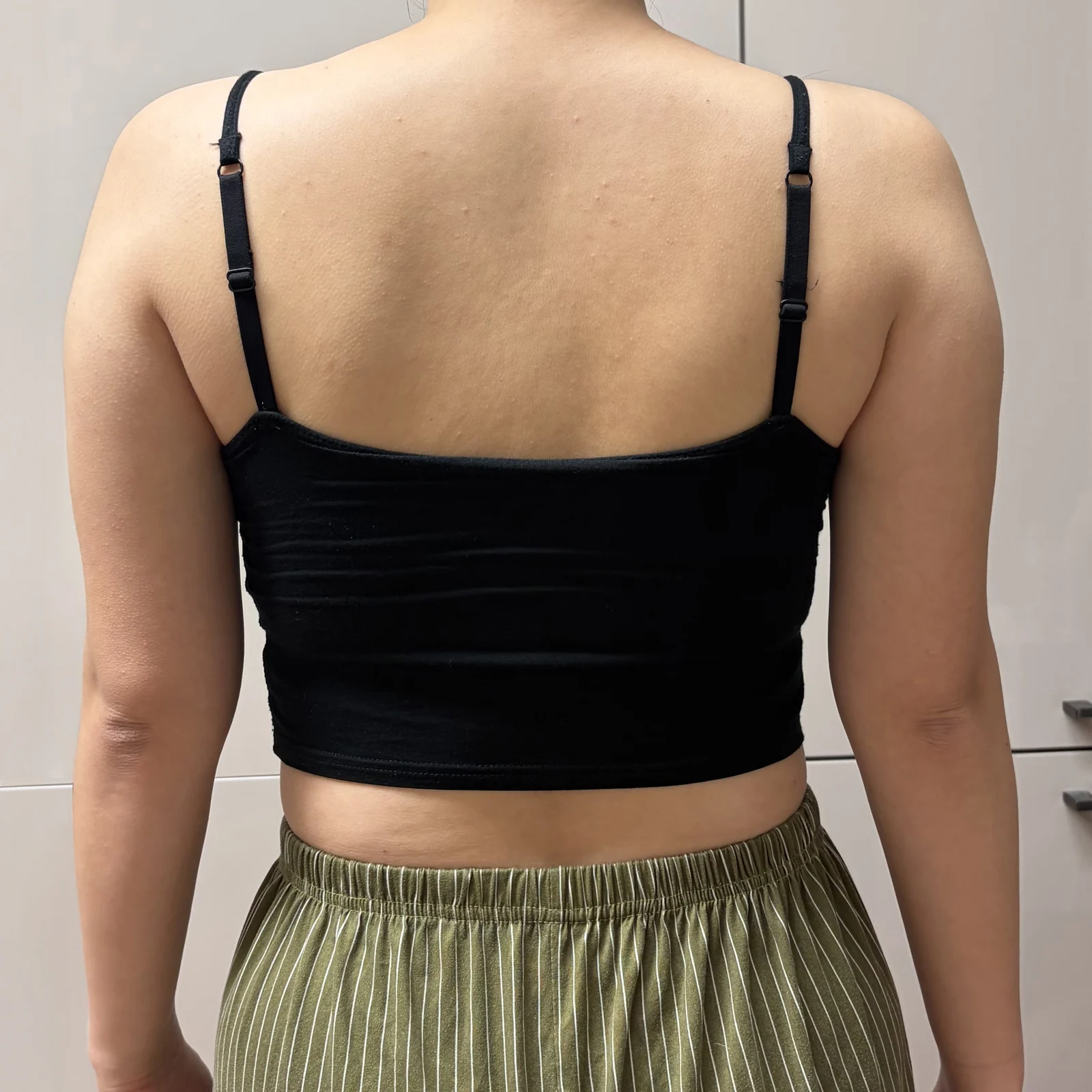My one-month review of upper arm liposuc - Arm Liposuction Before 2 - TheLINE Plastic Surgery