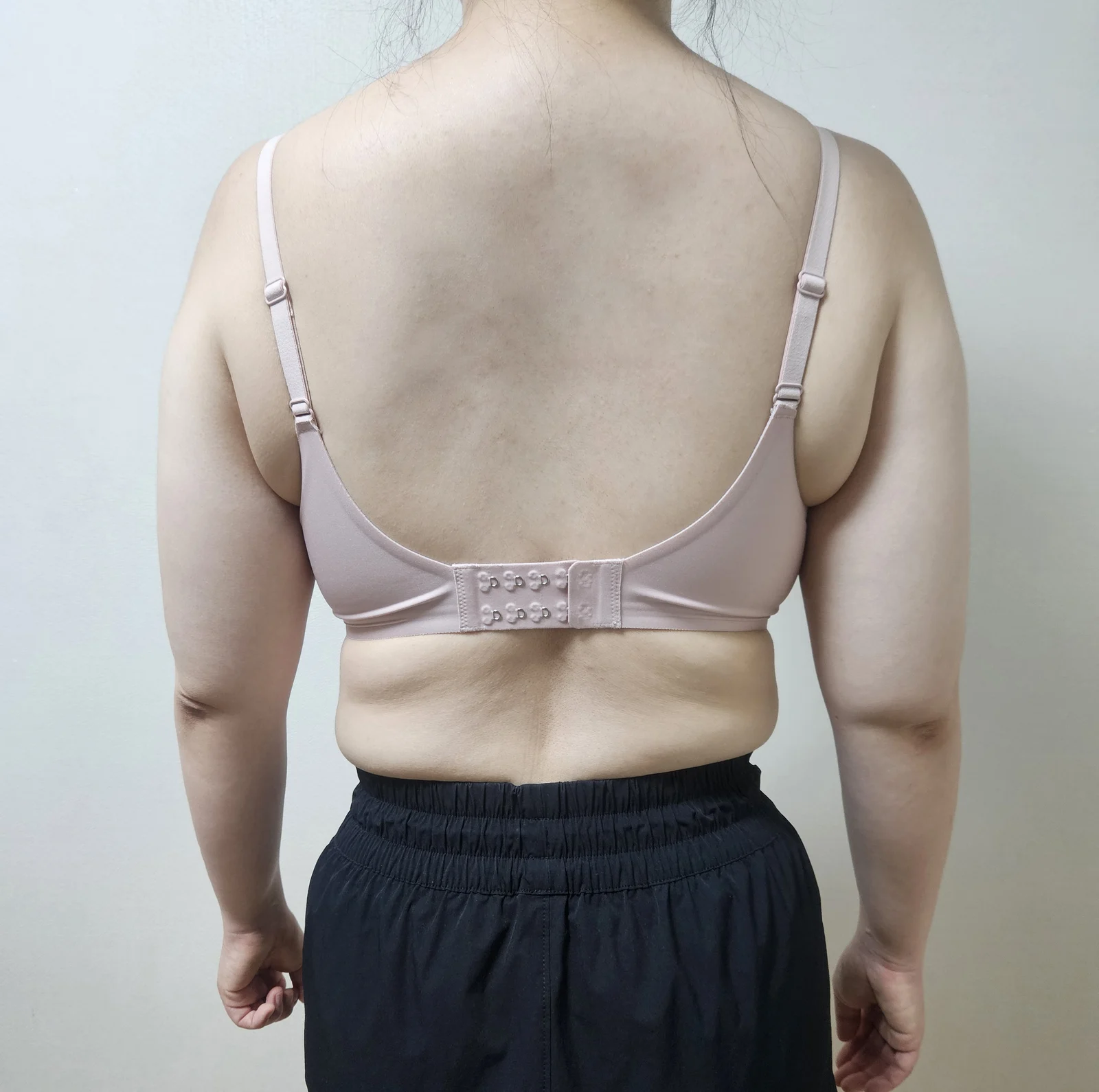 It's been 6 months since my arm liposuct - Arm Liposuction Before 2 - TheLINE Plastic Surgery