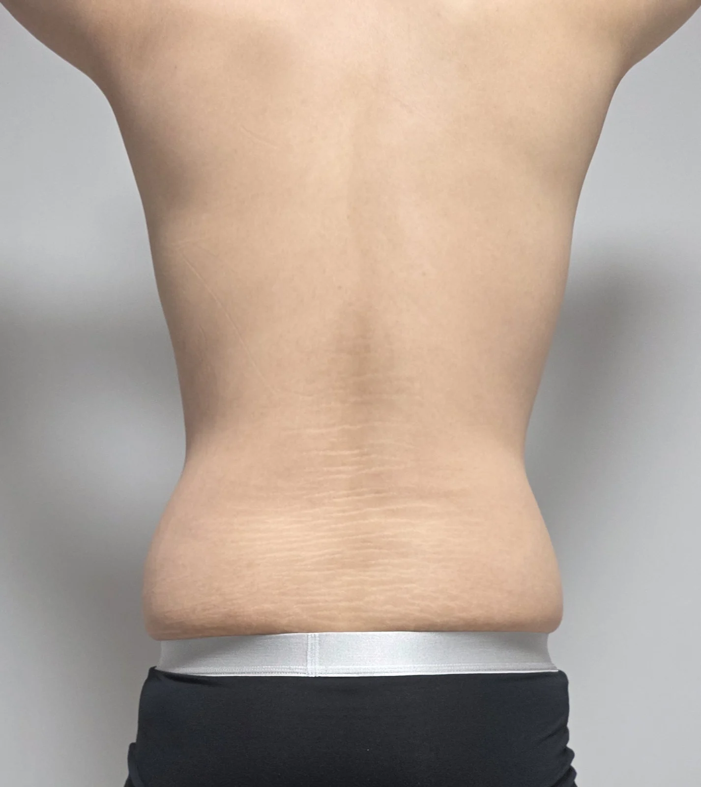 Review of abdomen and flank liposuction - Abdominal Liposuction (Upper Body) Before 2 - TheLINE Plastic Surgery