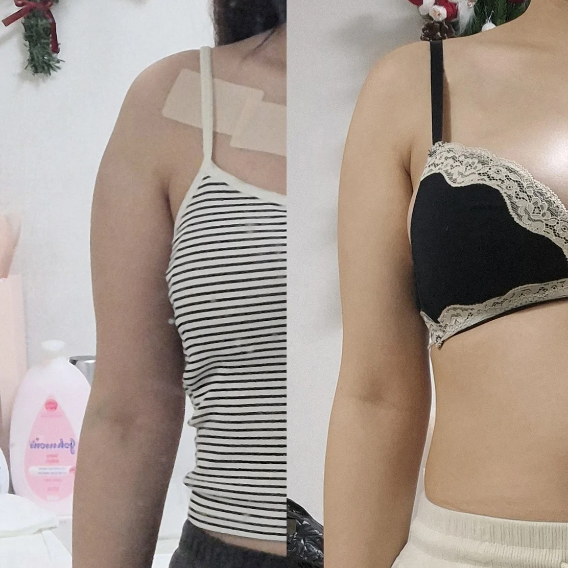 One month after arm lipo with Dr. Joongj - Arm Liposuction Before 2 - TheLINE Plastic Surgery