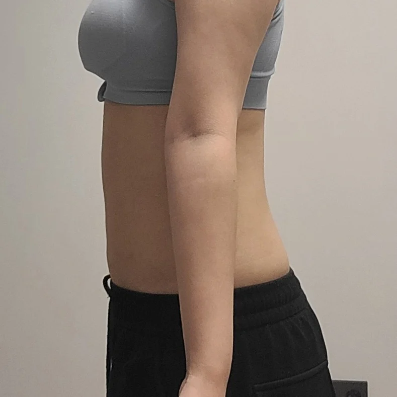 Posting my 6-month review of abdominal l - Abdominal Liposuction (Upper Body) After 4 - TheLINE Plastic Surgery