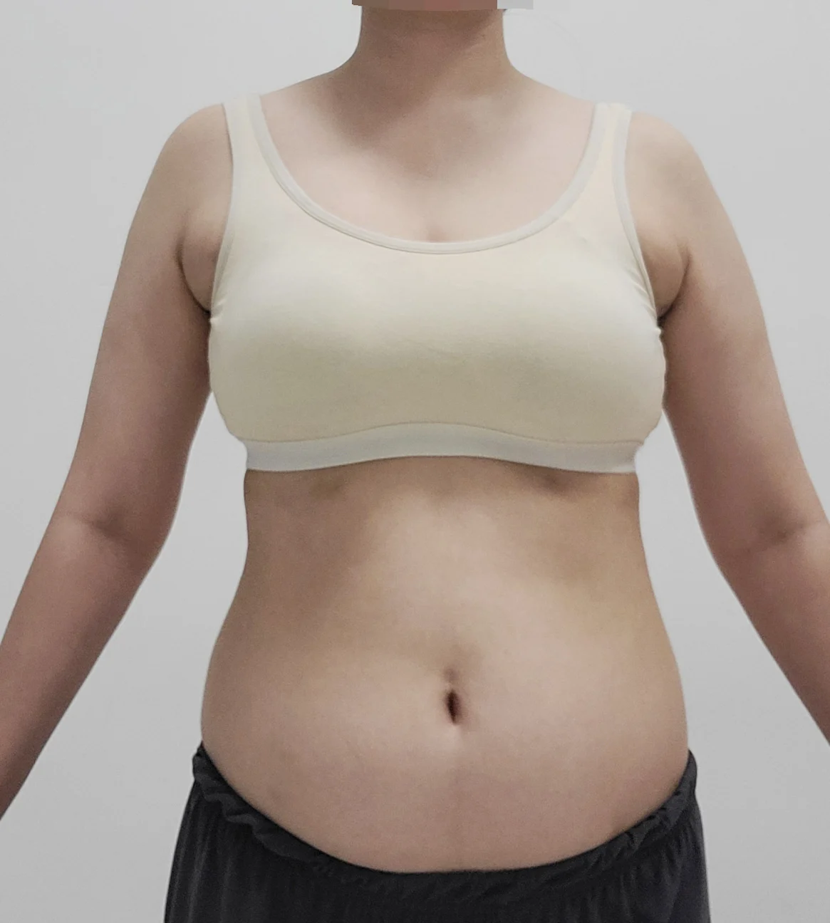 Posting my 6-month review of abdominal l - Abdominal Liposuction (Upper Body) surgery Before photo - TheLINE Plastic Surgery