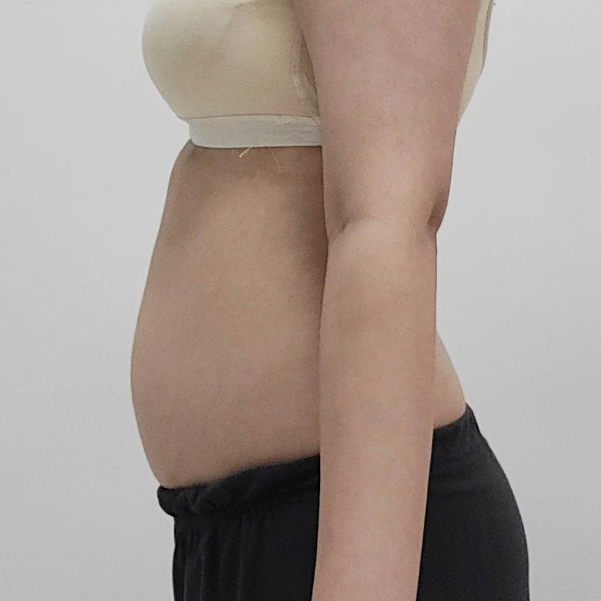 Posting my 6-month review of abdominal l - Abdominal Liposuction (Upper Body) Before 2 - TheLINE Plastic Surgery