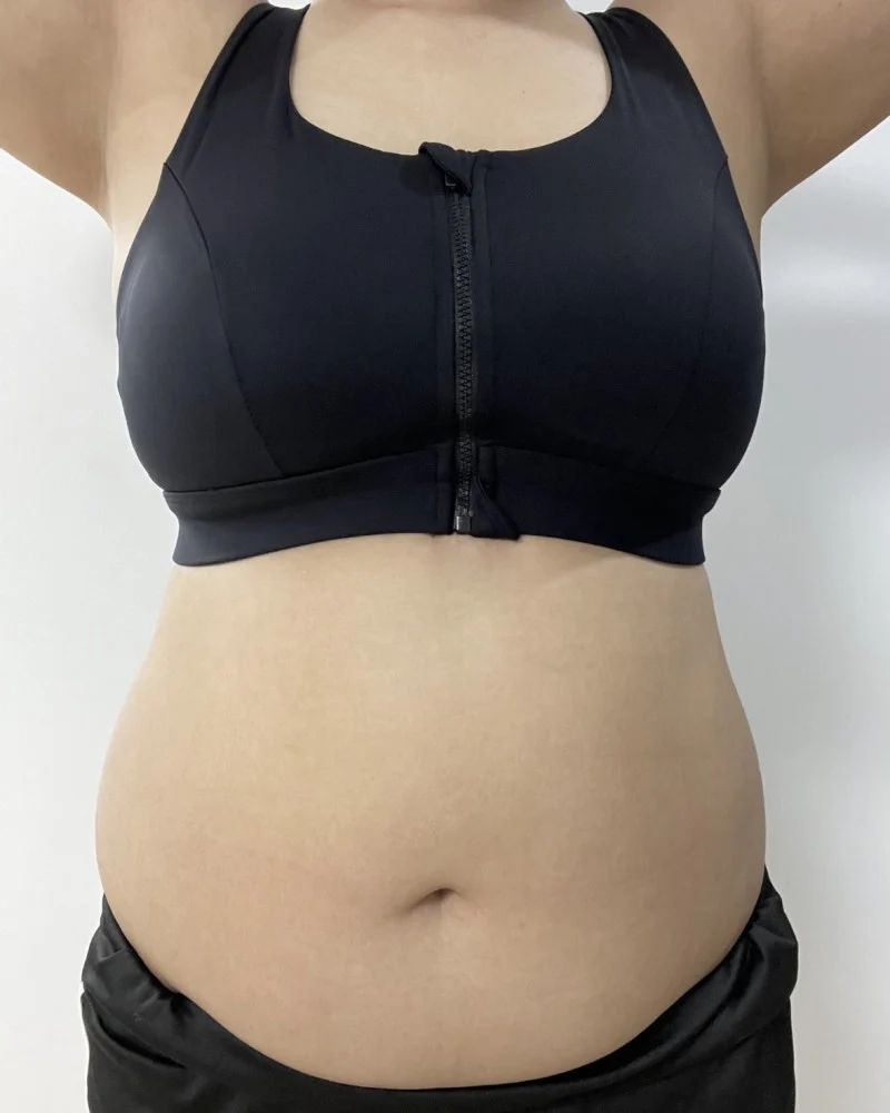 My 3-month review after lipo - Abdominal Liposuction (Upper Body) Before 2 - TheLINE Plastic Surgery