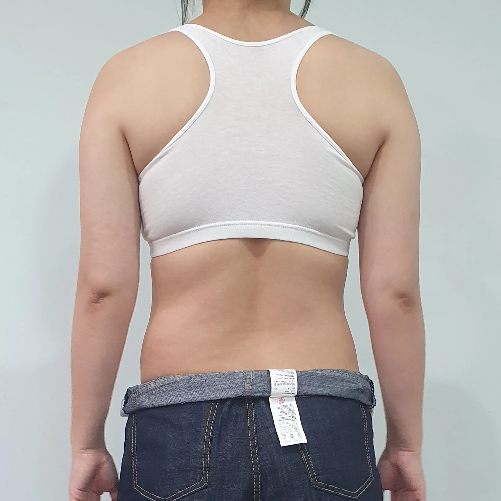It's been 3 months since my abdomen and  - Arm Liposuction Before 2 - TheLINE Plastic Surgery