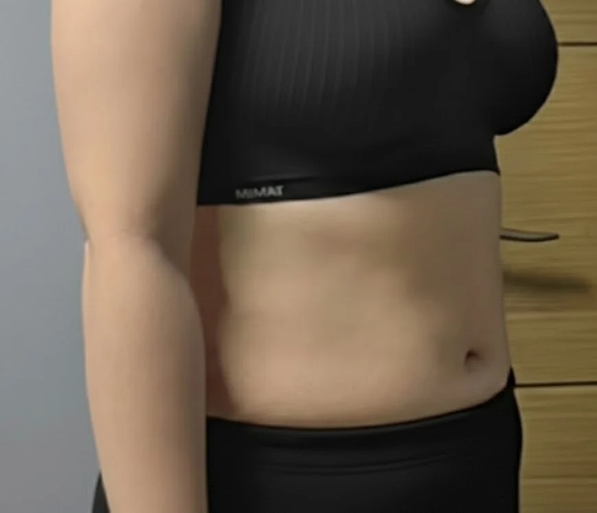 Leaving my 3-month abdominal lipo review - Abdominal Liposuction (Upper Body) Before 2 - TheLINE Plastic Surgery