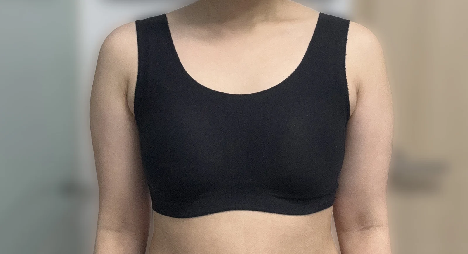 I had arm and accessory breast tissue li - Arm Liposuction Before 2 - TheLINE Plastic Surgery