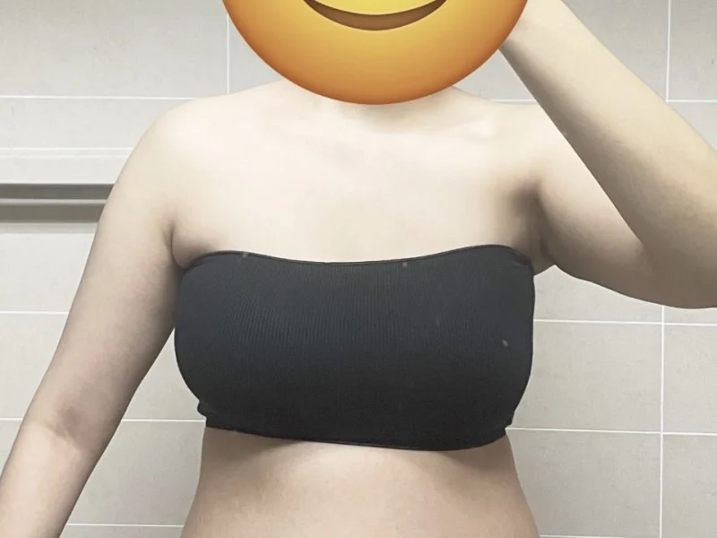 Arm liposuction - Arm Liposuction Before 2 - TheLINE Plastic Surgery