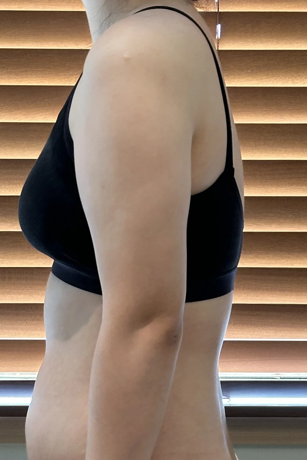 Arm lipo review - Arm Liposuction Before 2 - TheLINE Plastic Surgery