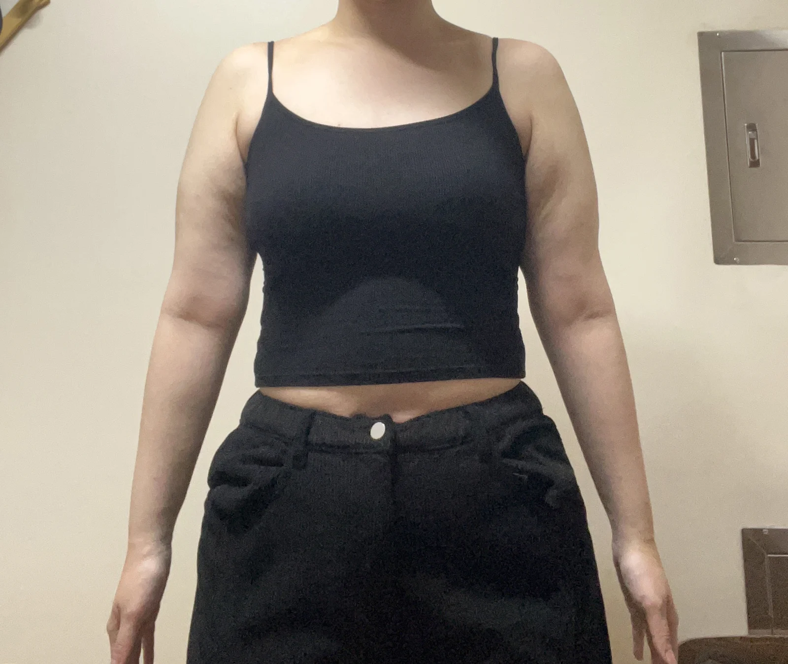 My arm liposuction review with Dr. Jaeho - Arm Liposuction surgery Before photo - TheLINE Plastic Surgery