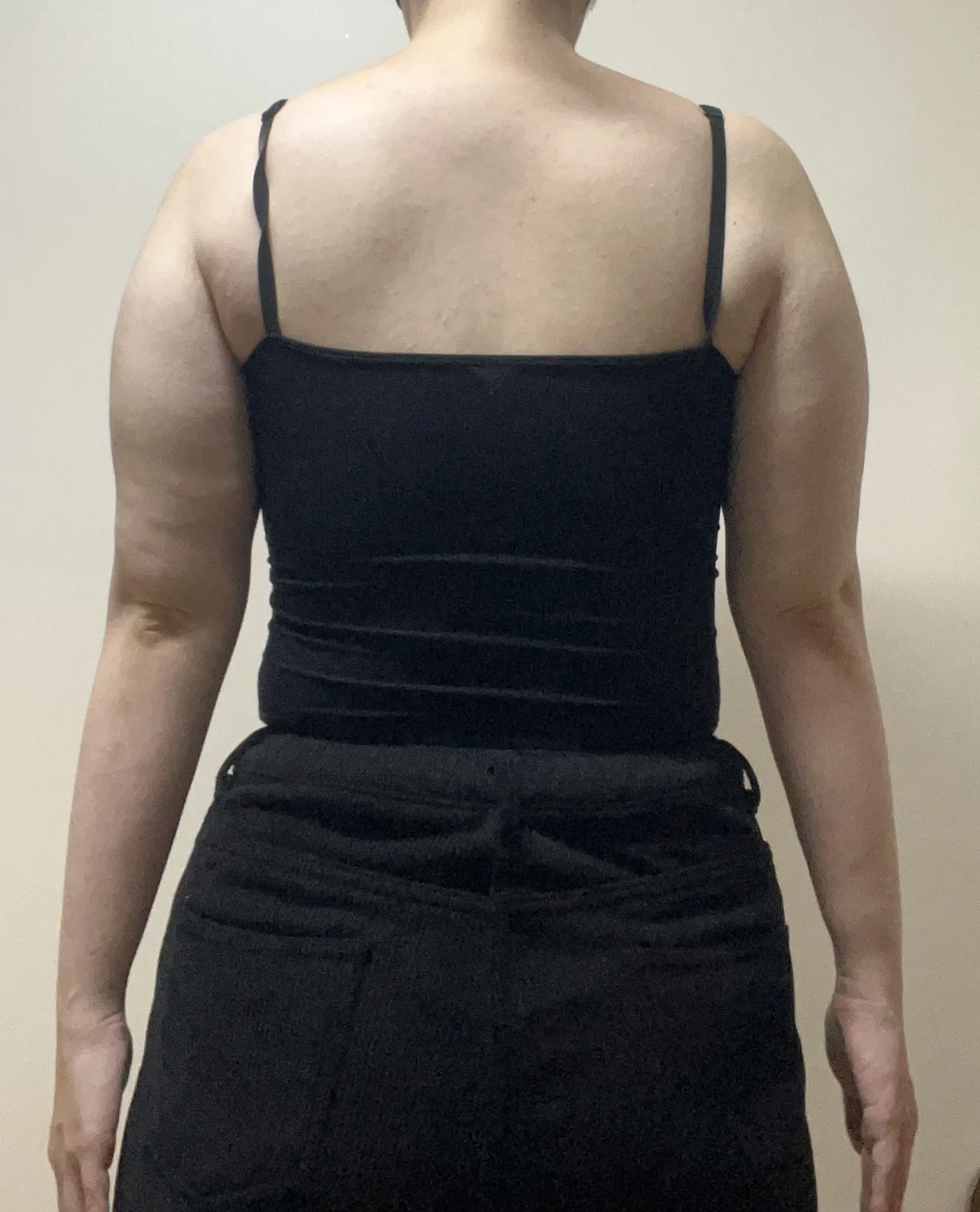 My arm liposuction review with Dr. Jaeho - Arm Liposuction Before 2 - TheLINE Plastic Surgery