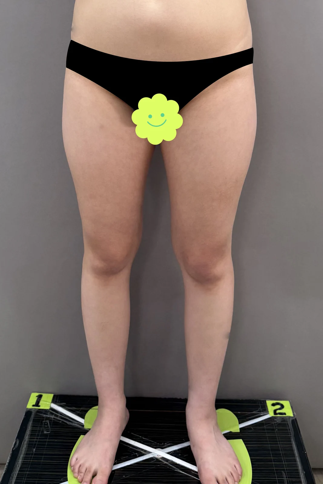 Leaving my one-month review^^ - Arm Liposuction Before 2 - TheLINE Plastic Surgery