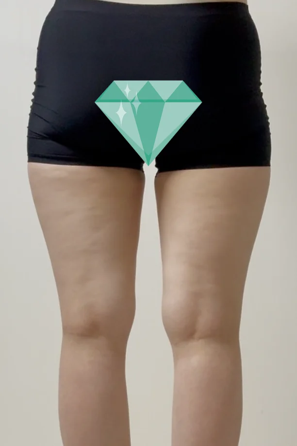 It's been 6 months since my thigh lipo a - Thigh Liposuction (Lower Body) Before 2 - TheLINE Plastic Surgery