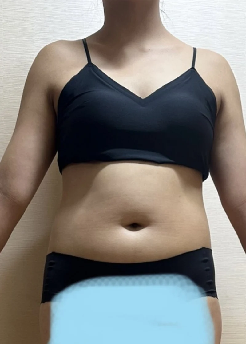 Satisfied - Arm Liposuction Before 2 - TheLINE Plastic Surgery