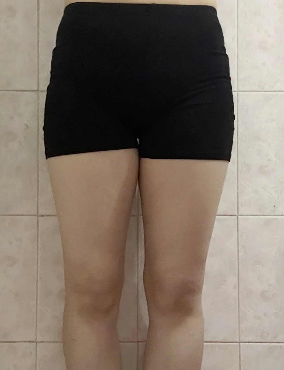 ~3-month review of lower body lipo & hip - Thigh Liposuction (Lower Body) Before 2 - TheLINE Plastic Surgery