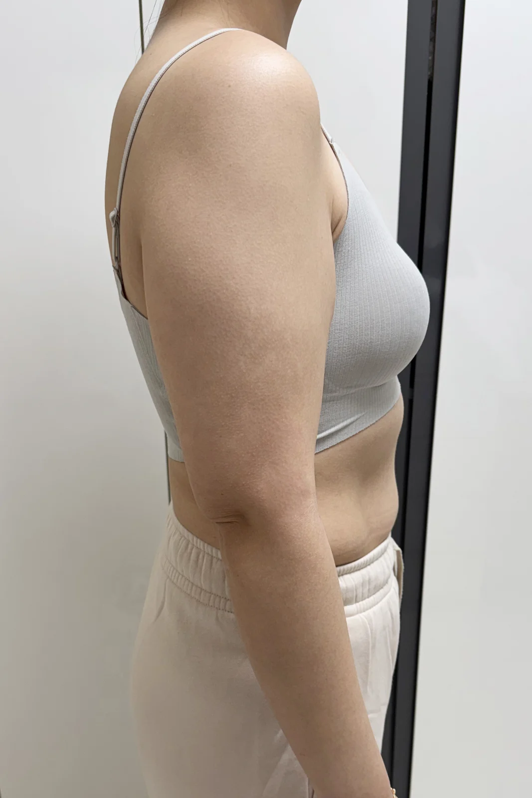 My review of 360° arm lipo + arm lift! - Arm Liposuction Before 2 - TheLINE Plastic Surgery