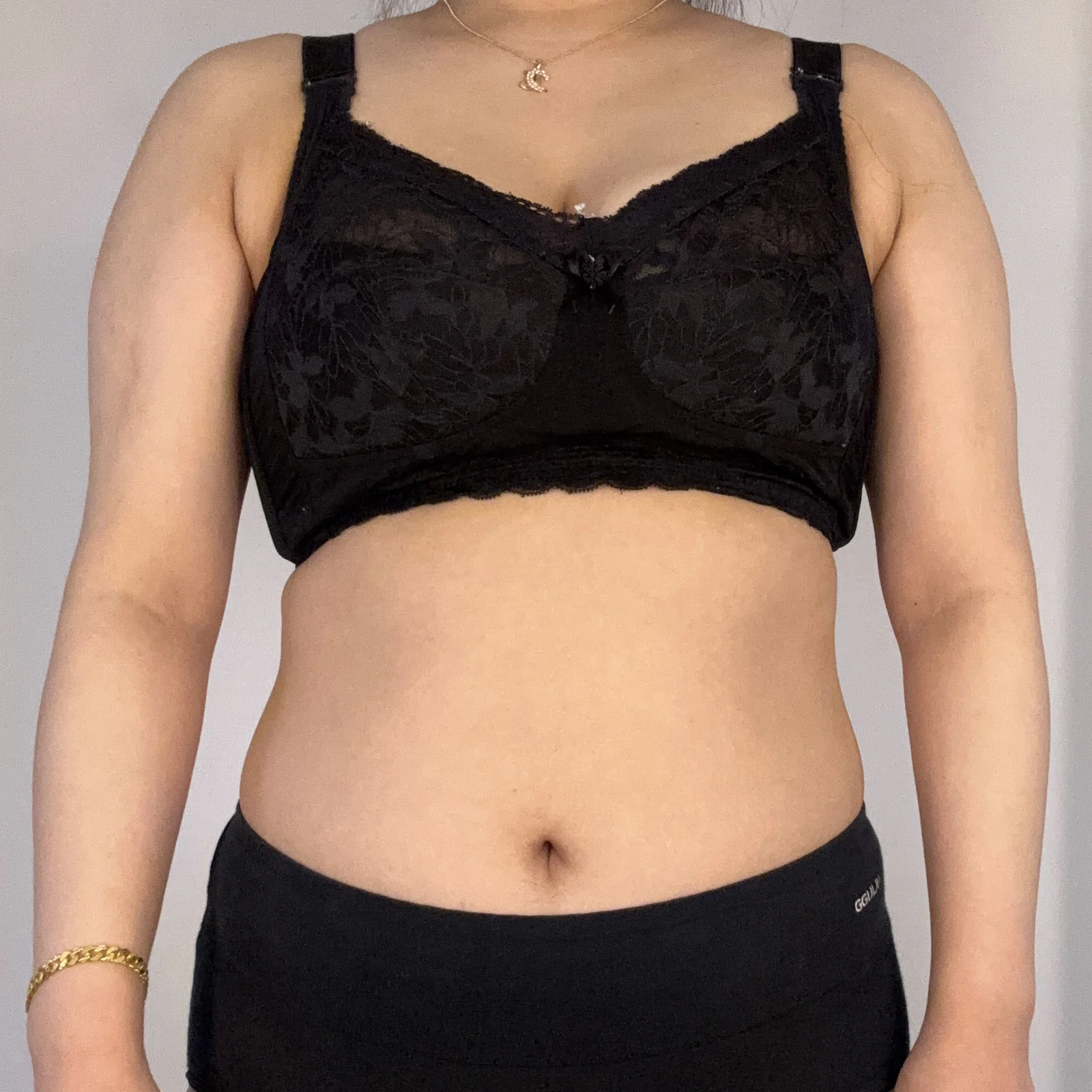 My review after 360° arm and accessory b - Arm Liposuction Before 2 - TheLINE Plastic Surgery